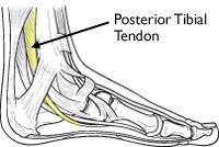 Diagram of the posterior tibial tendon